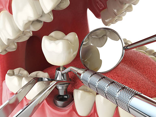 Best Emergency Tooth Extraction in Glenpool, OK
